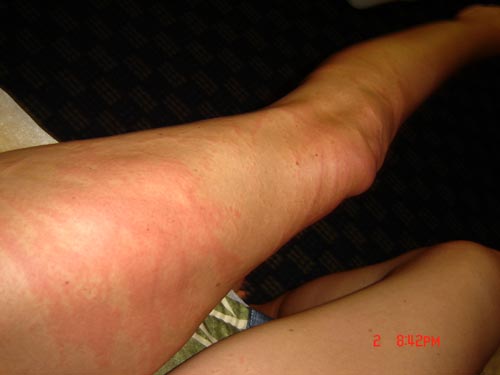 Jellyfish sting injury to legs and thighs.