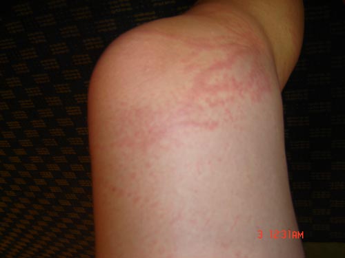 Jellyfish sting injury to knee and thigh.