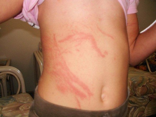 Jellyfish injury to child's side and abdomen. Lisa D. 